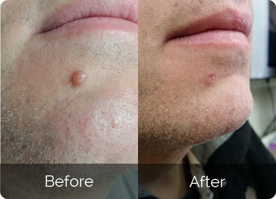 Skin Tag Remover