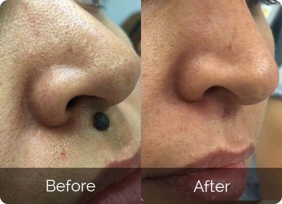 Skin Tag Remover