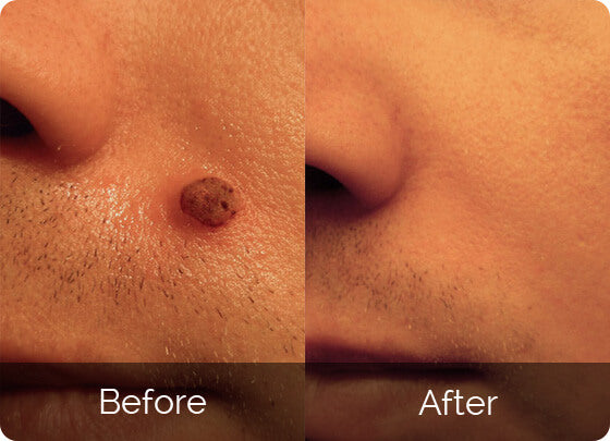 Skin Tag Remover