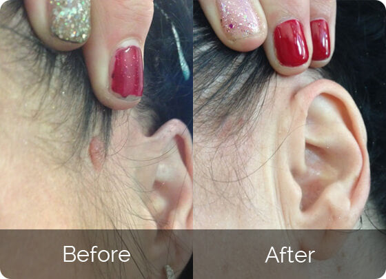Skin Tag Remover