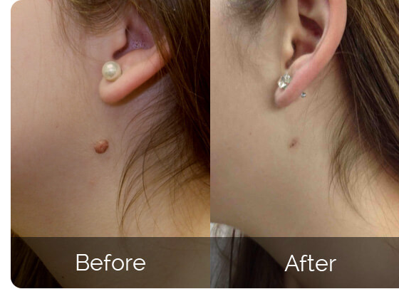Skin Tag Remover