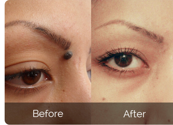 Skin Tag Remover