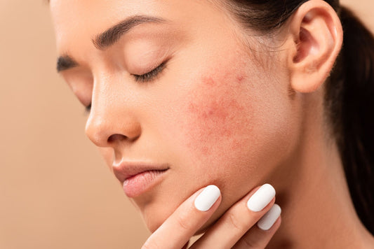 How to Treat Stress-Caused Skin Blemishes