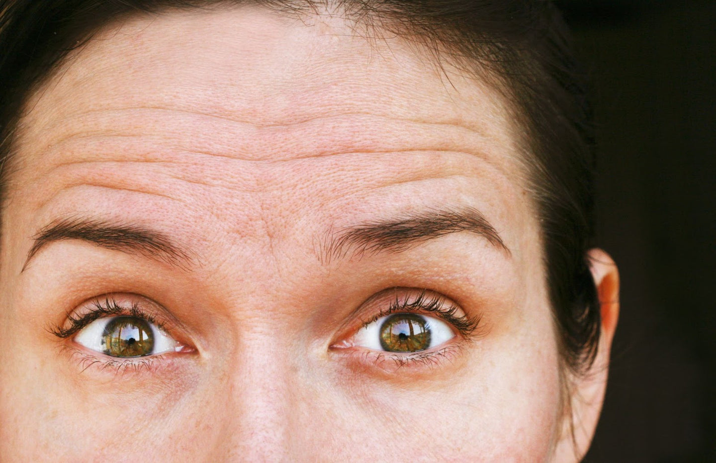 How to Get Rid of the First Wrinkles on the Forehead With No Surgery